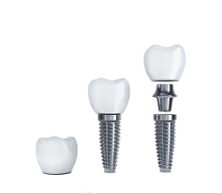 Коронка на имплант